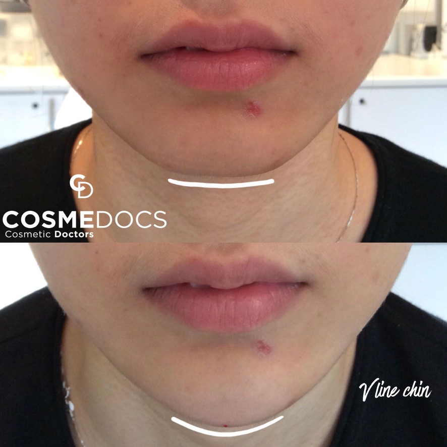 Before and after chin filler showing V-line chin enhancement and projection