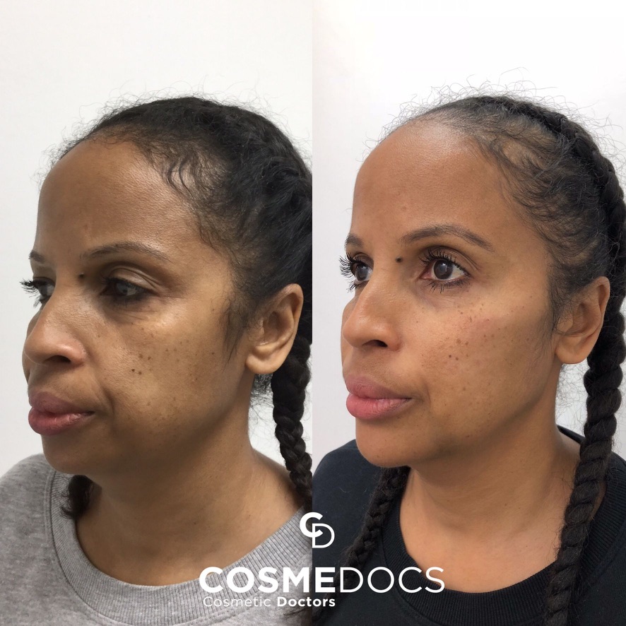 Before and after chin filler demonstrating facial rejuvenation and chin augmentation