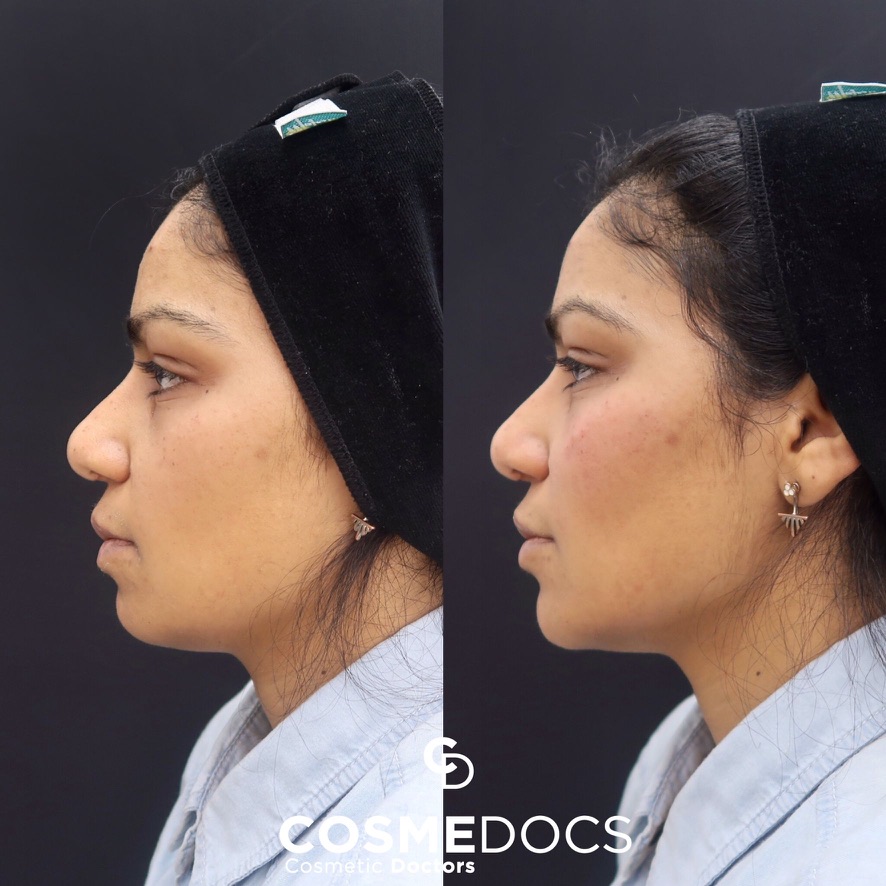 Before and after jawline filler showing profile improvement and mandibular contouring