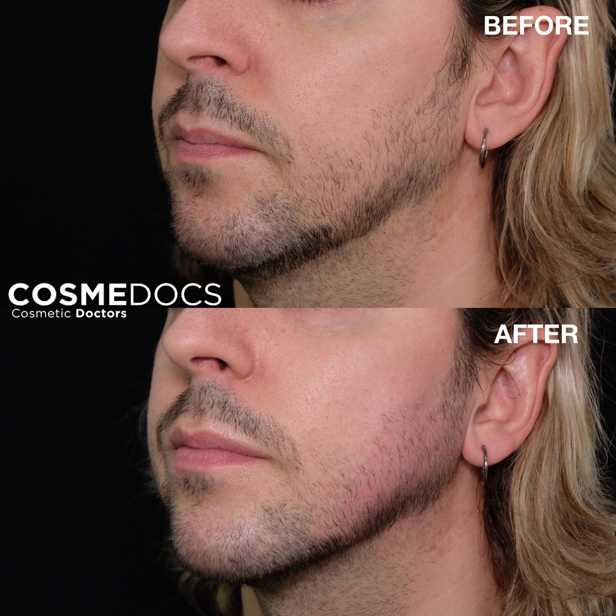 Before and after jawline filler showing masculine jawline sculpting