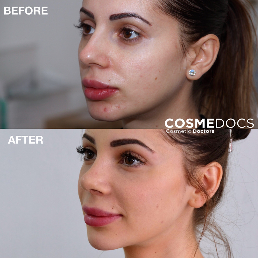 Before and after jawline filler showing facial contouring and jawline enhancement