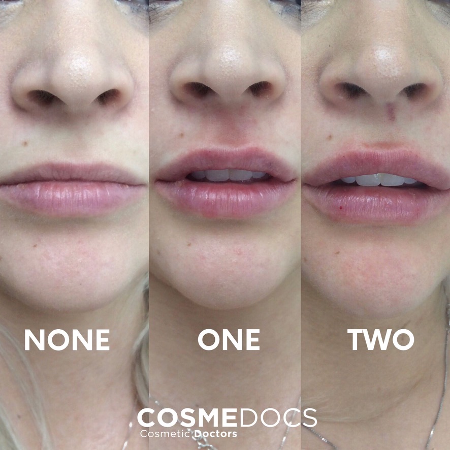 Lip filler progression showing results after one and two treatment sessions