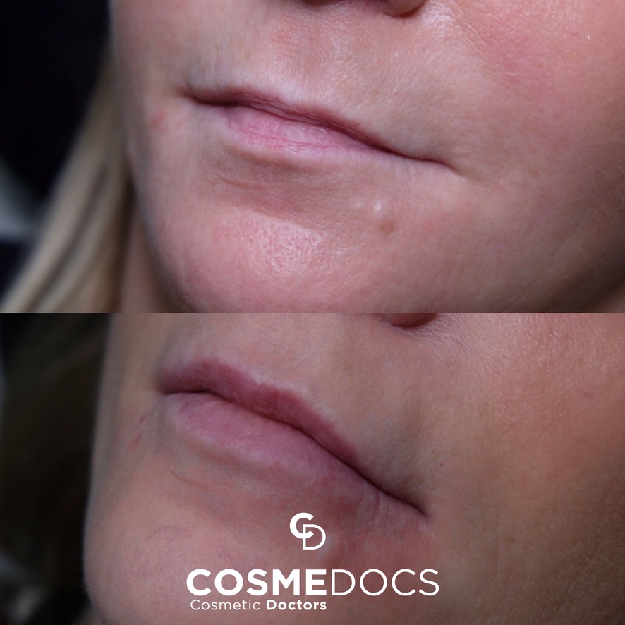 Lip filler before and after side profile showing improved definition