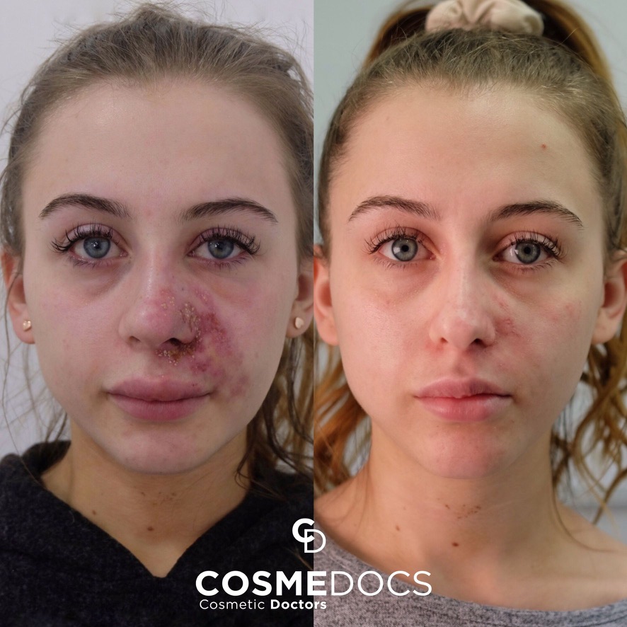 Vascular occlusion complication management before and after showing complete recovery