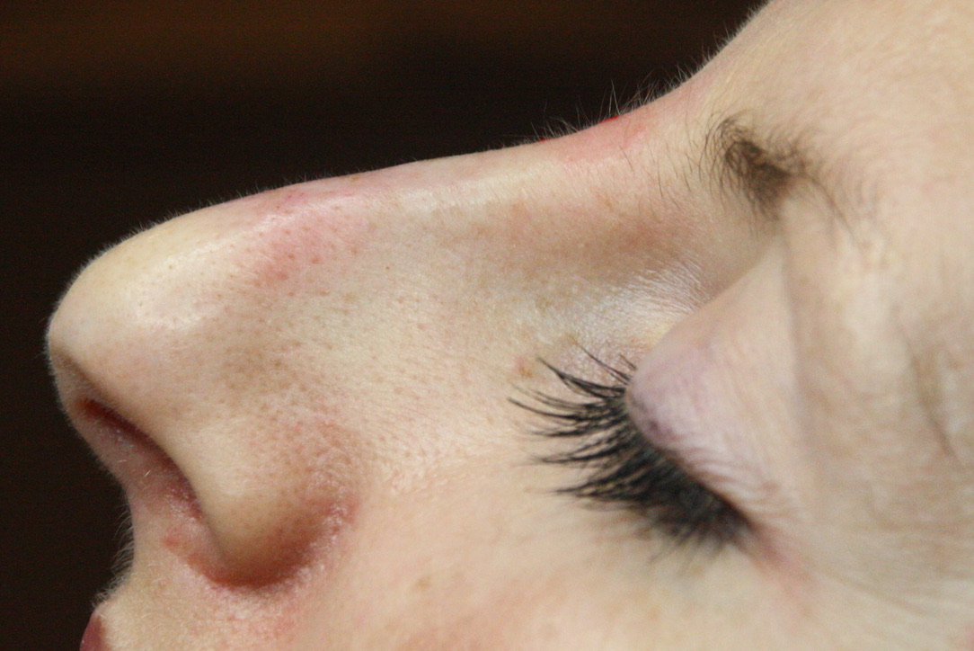 After non-surgical rhinoplasty showing smoothed dorsal bump and improved nasal contour