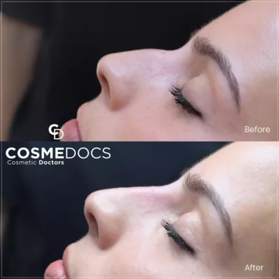 Nose bridge and tip refinement before and after showing improved profile