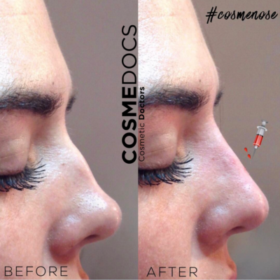 Double dip dorsal bump correction with nose filler before and after