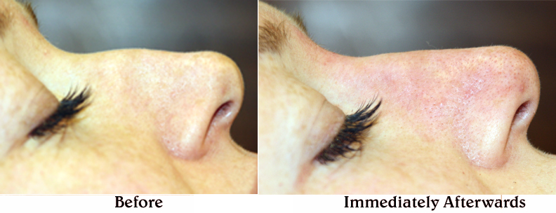 Non-surgical nose reshaping before and immediately after treatment from 2010