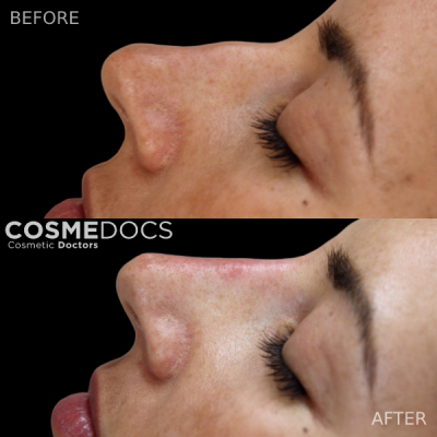 Post-surgical rhinoplasty complication corrected with dermal filler before and after