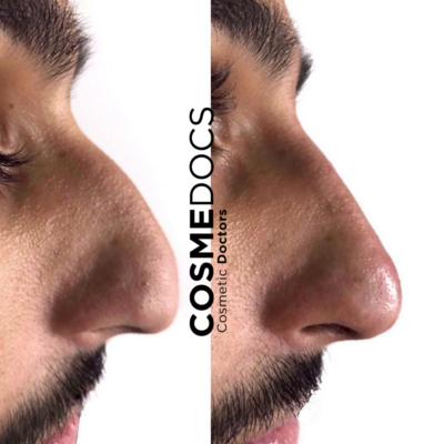 Nose tip transformation before and after non-surgical rhinoplasty