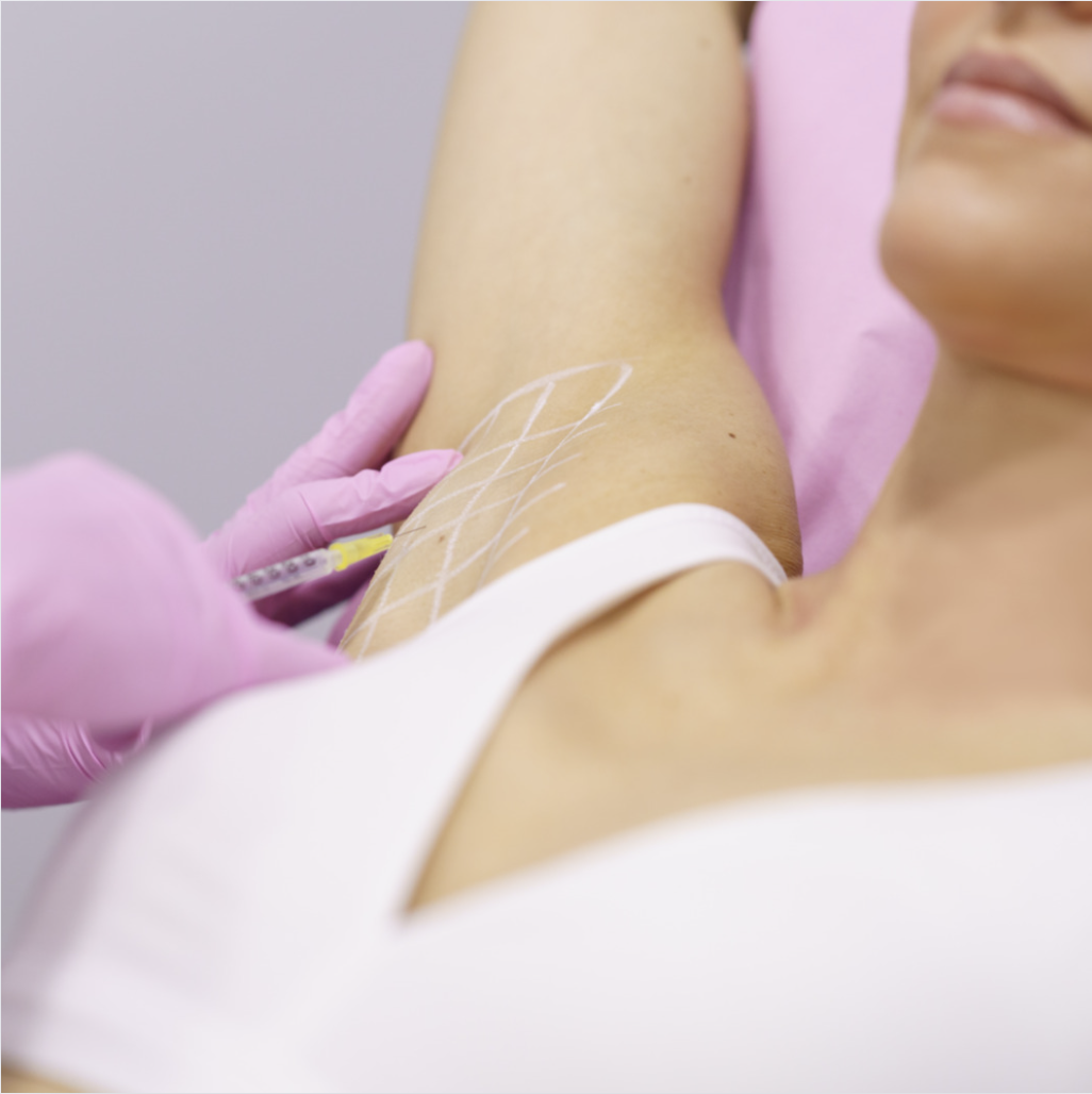 Botox in armpit injections showing treatment area