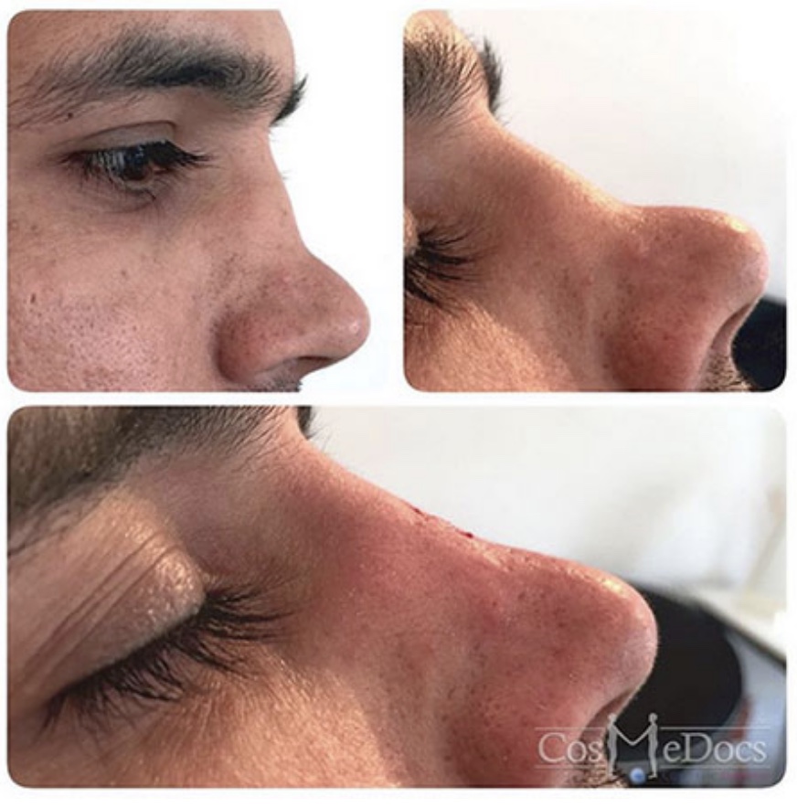 Complex nose fracture reconstruction London Harley Street Dr Ahmed Haq