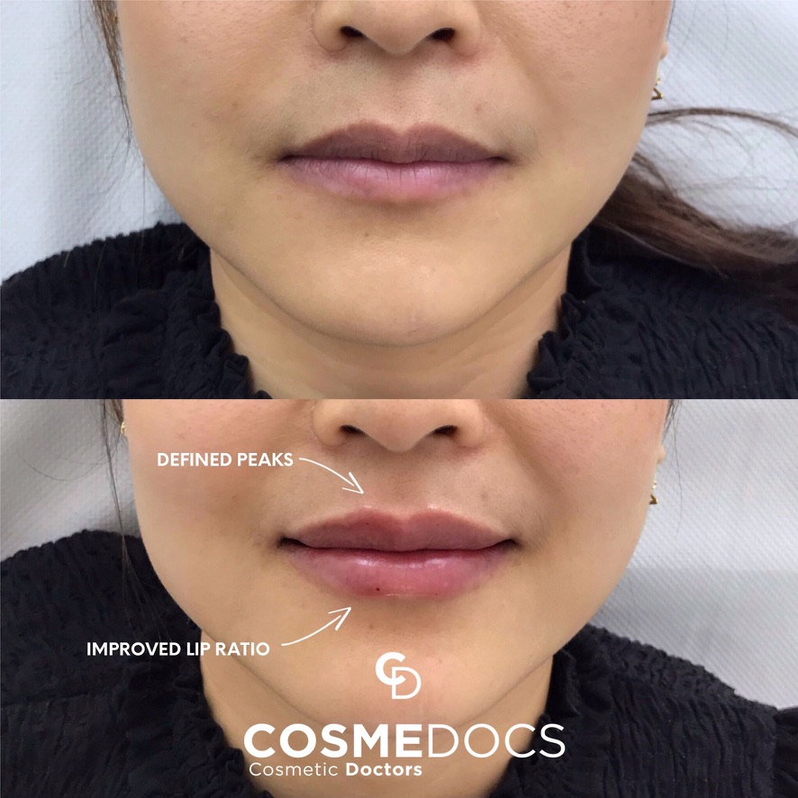 Before and after 1ml lip filler showing defined lip peaks and enhanced lip shape London
