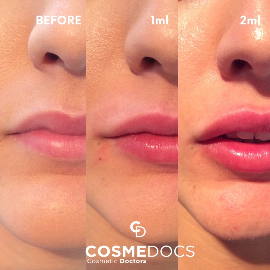 Before and after 0.5ml lip filler vs 1ml comparison showing different enhancement levels London