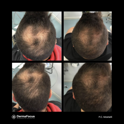 Polynucleotide treatment London hair restoration scalp therapy follicle regeneration results