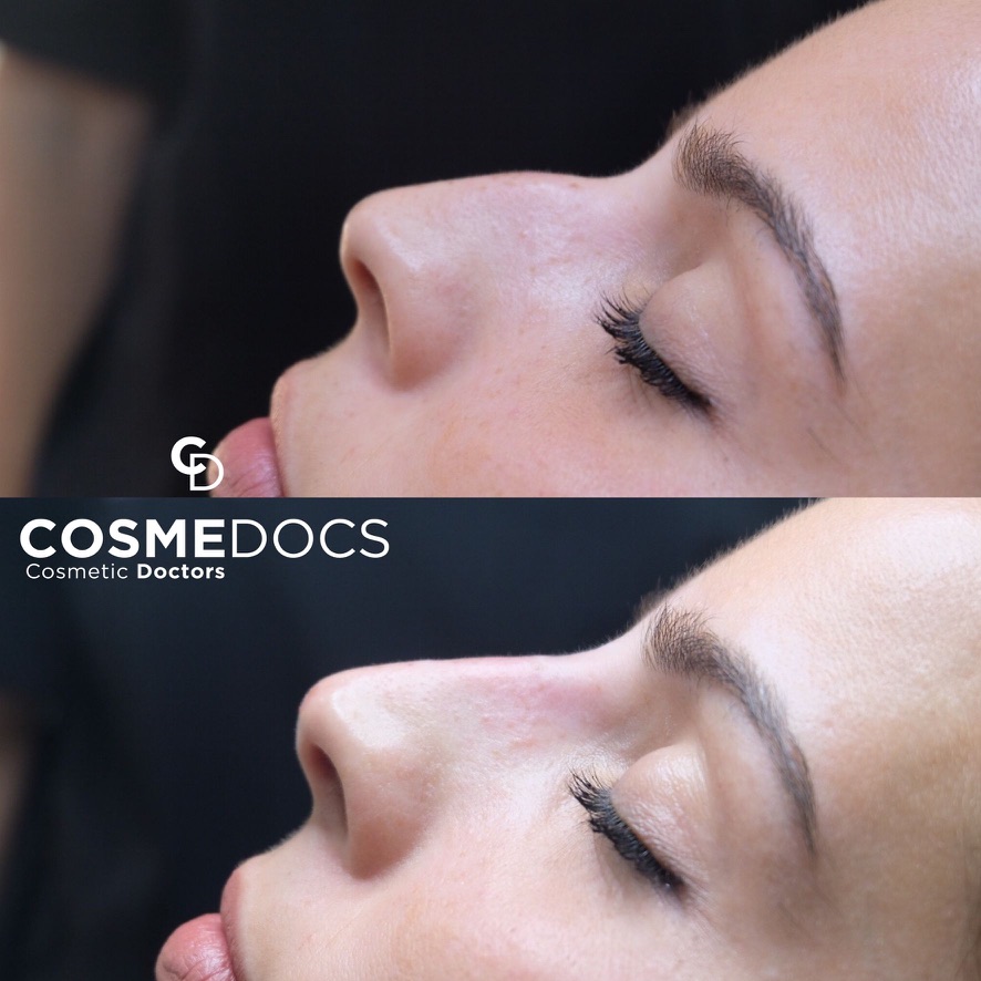 Liquid nose job profile view London Harley Street non-surgical rhinoplasty results