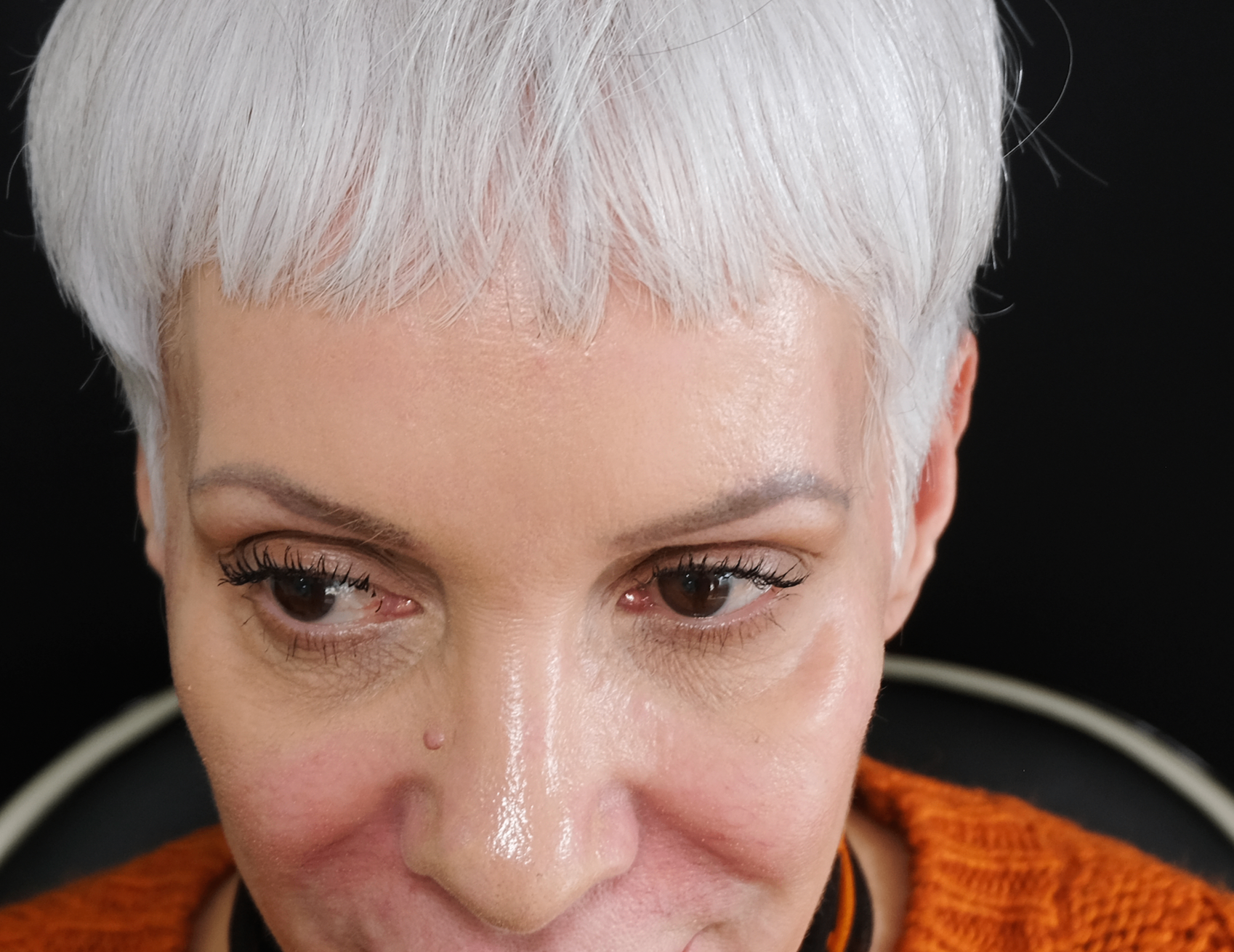 Temple hollowing before treatment - frontal view showing bilateral temple depression