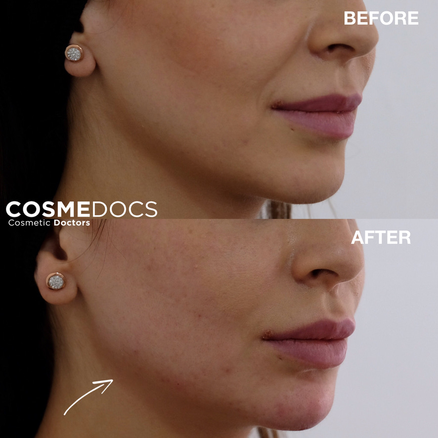 Dermal filler makeover jawline definition