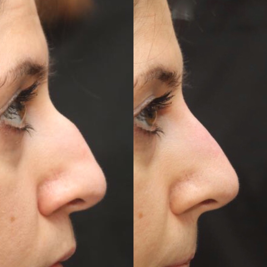 Nose reshaping profile dermal filler London Cosmedocs Dr Ahmed Haq