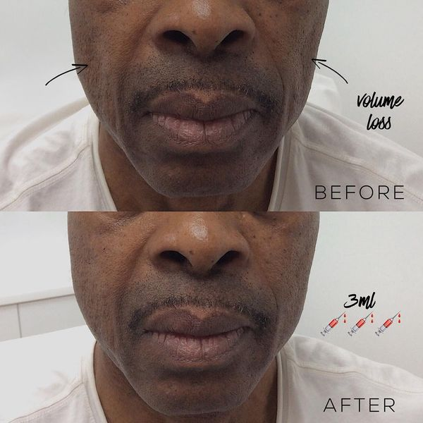 3ml male cheek filler before and after volume loss correction London
