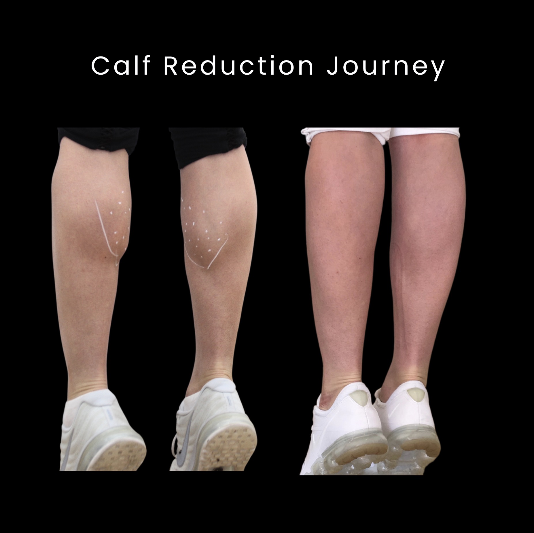 小腿减少治疗过程显示渐进式瘦身效果