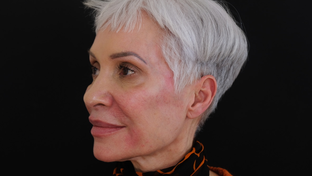 Temple filler before and after comparison - side profile showing dramatic volume restoration