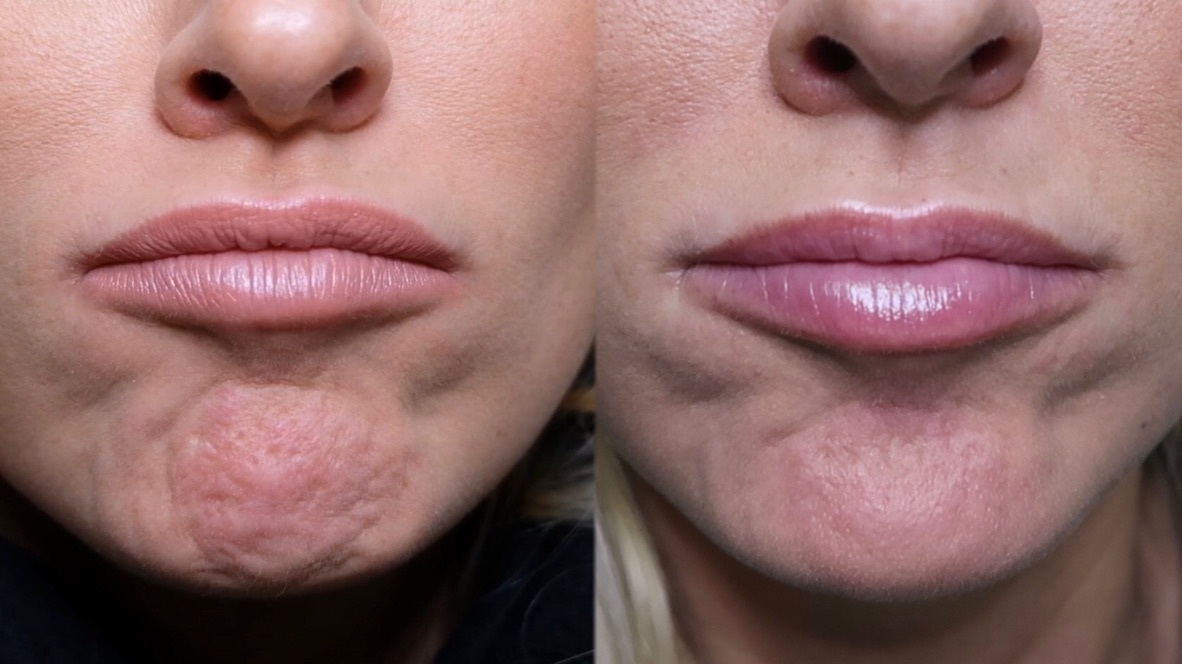 Nasal flaring botox before and after treatment