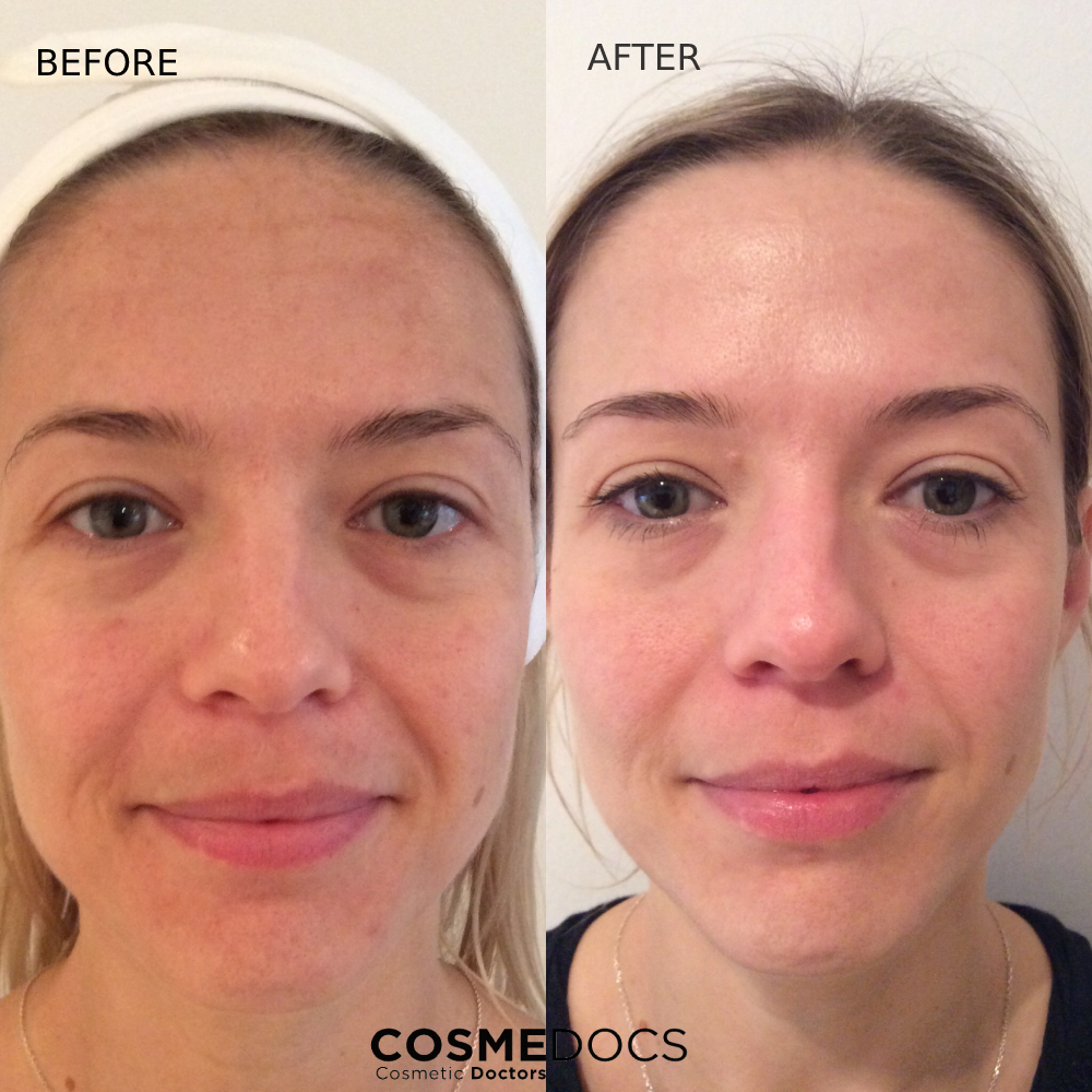 Chemical peel before and after skin improvement London Cosmedocs