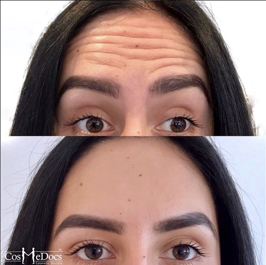 Botox London prices - forehead lines before and after treatment at best botox clinic London