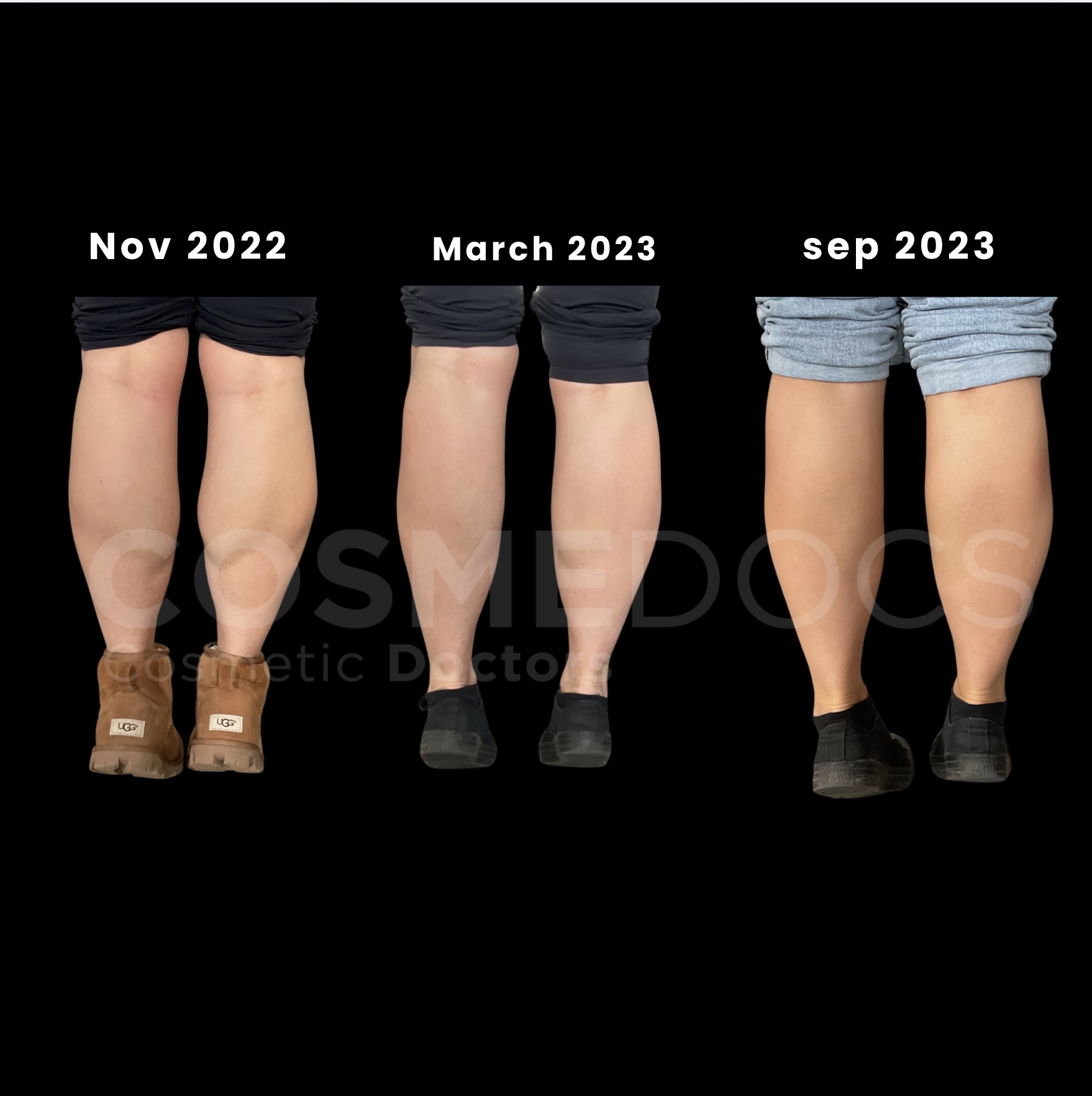 小腿减少治疗效果数月时间线进展