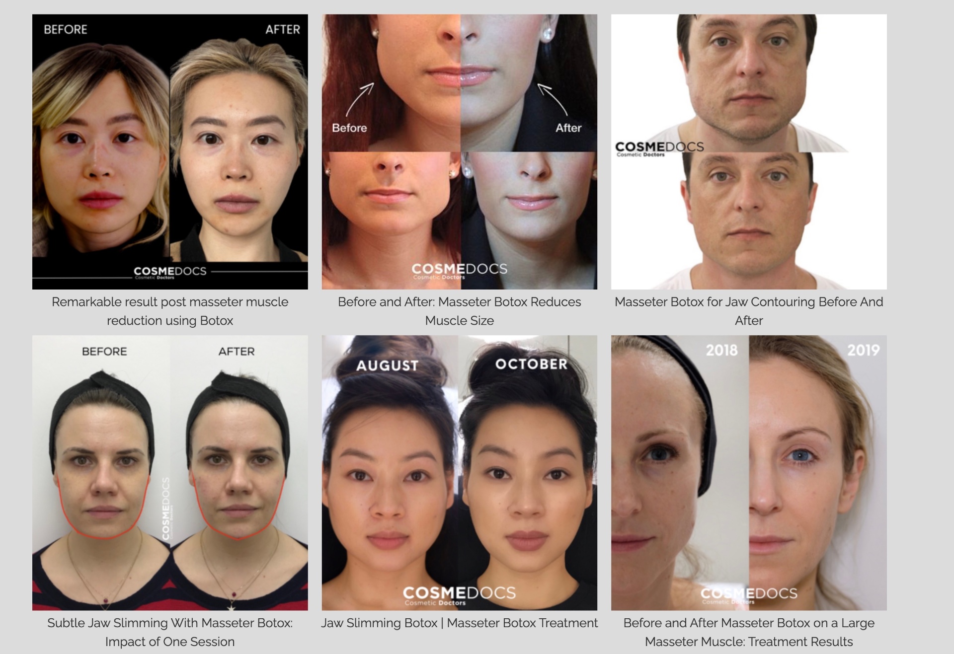 Masseter Botox comprehensive results gallery