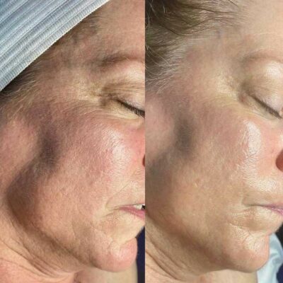 HydraFacial before and after London Cosmedocs skin texture improvement