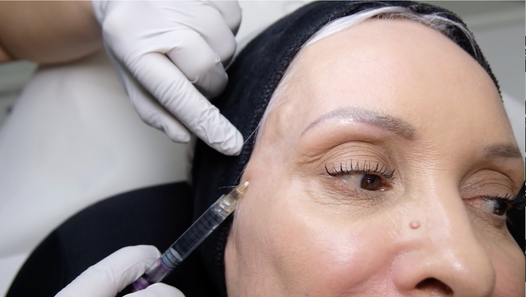 Professional temple filler injection procedure being performed by qualified aesthetic practitioner