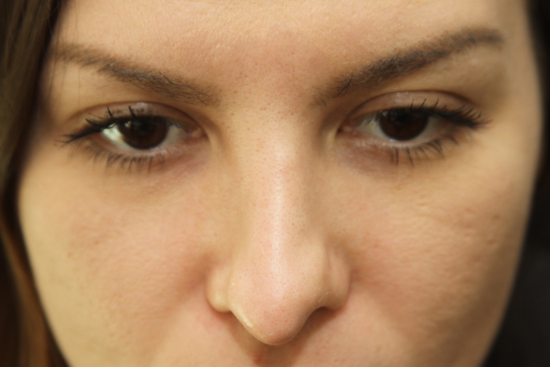 Before deviated nose correction London Harley Street Cosmedocs