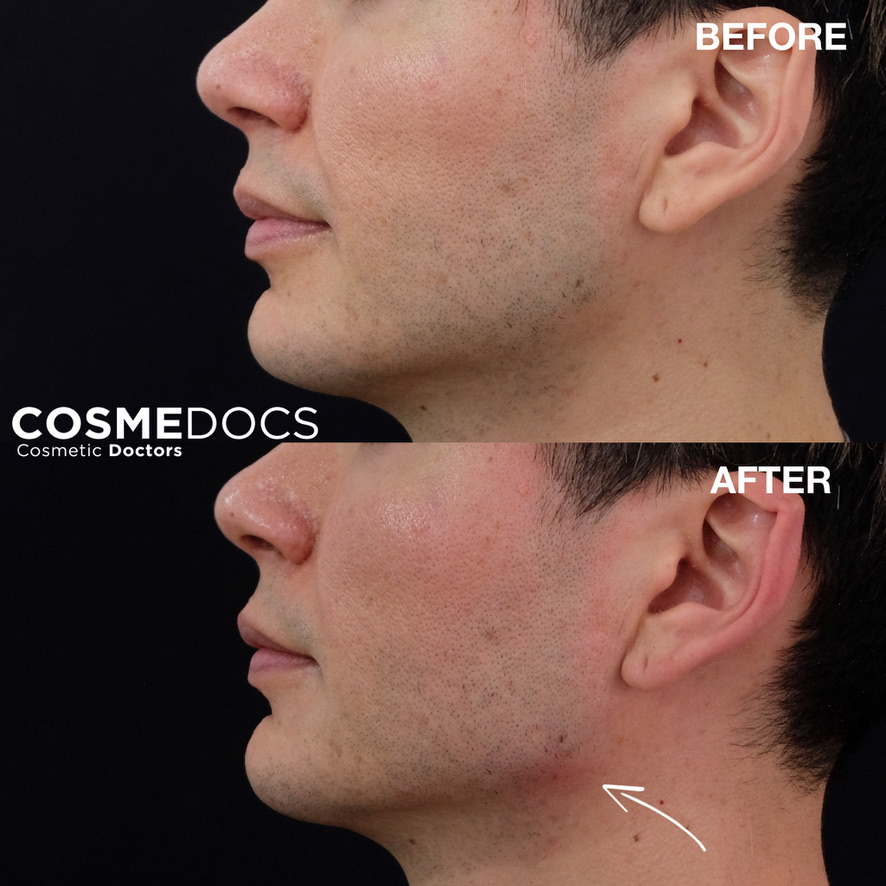 Dermal filler makeover male jawline