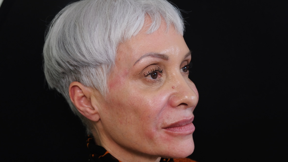 Final temple filler results showing natural-looking enhancement and facial rejuvenation