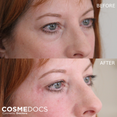 Eye bag improvement with dermal fillers