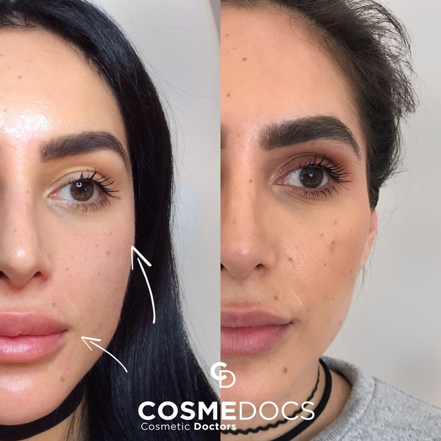 Cheek Fillers before and after