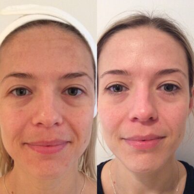 HydraFacial complexion enhancement before after London Harley Street treatment