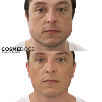Male masseter Botox before and after jaw reduction