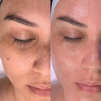 HydraFacial pigmentation treatment before after London Harley Street Cosmedocs