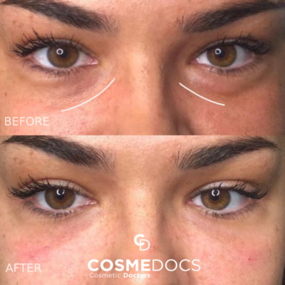 Under eye filler results showing brighter eyes