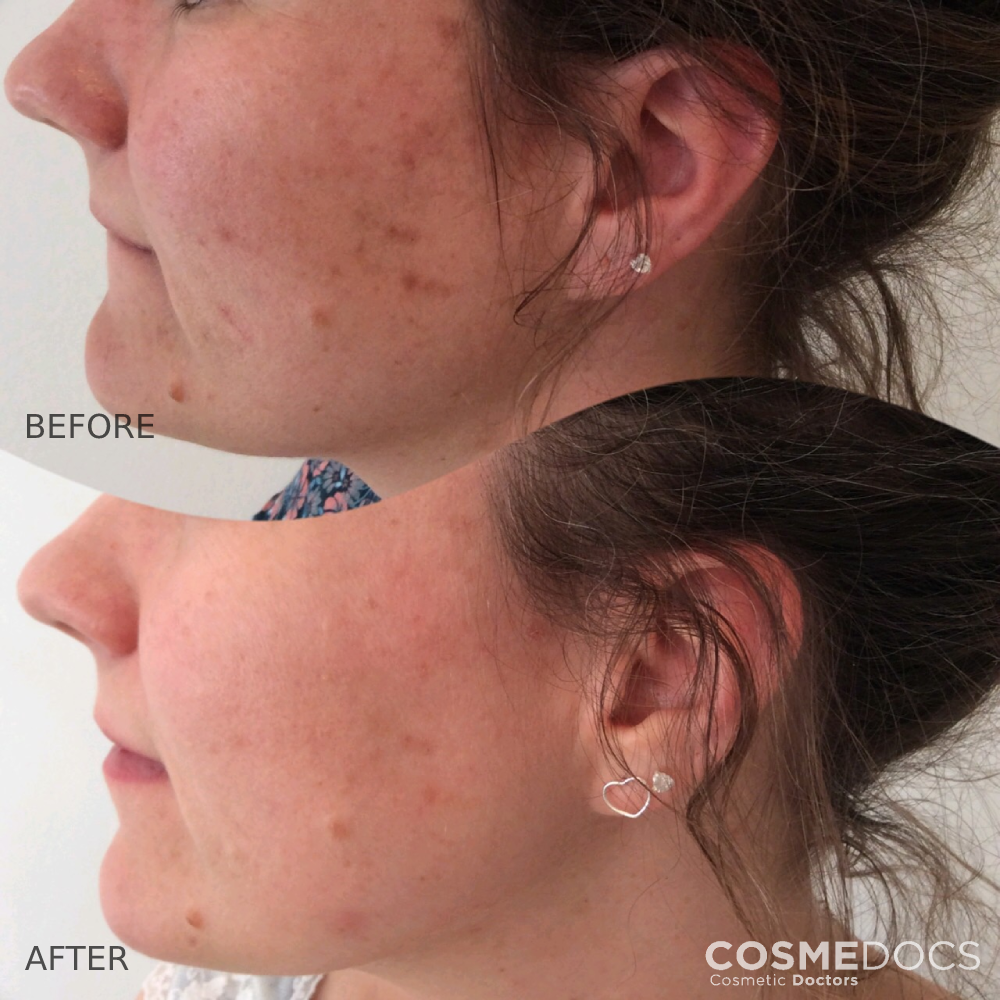 Chemical peel profile view results London treatment