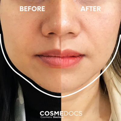 Jawline contouring before and after with masseter Botox