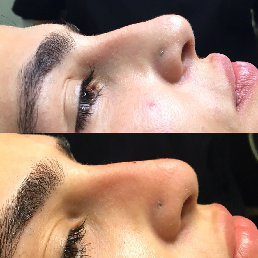 Non-surgical nose job bottom view nasal tip filler London Cosmedocs