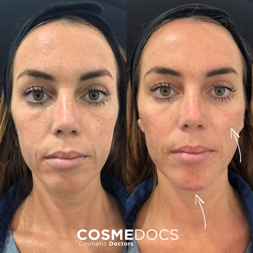Dermal filler makeover before and after front view