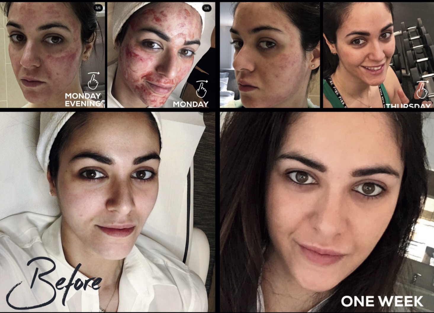 Microneedling 7-day transformation journey