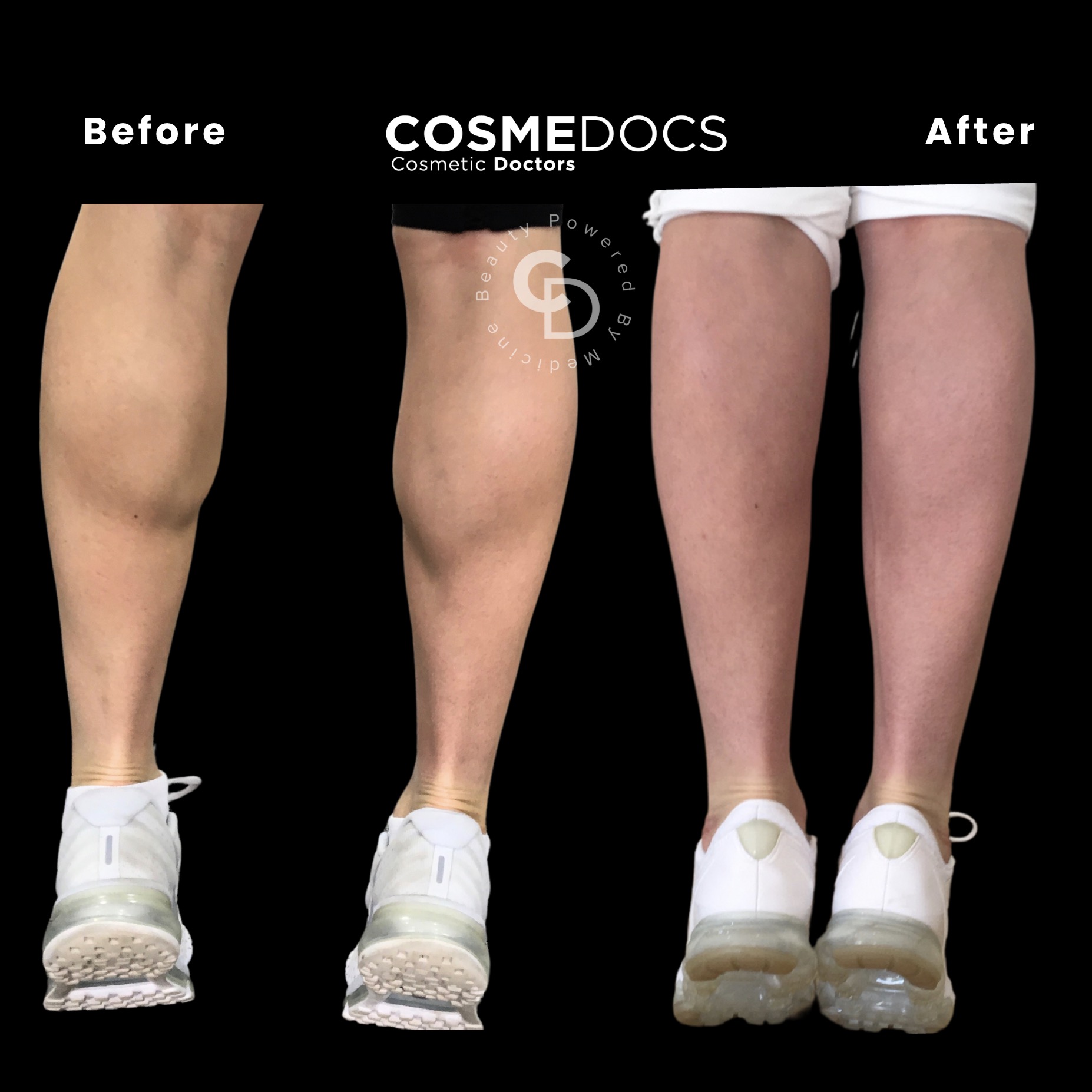 肉毒杆菌瘦小腿前后对比效果