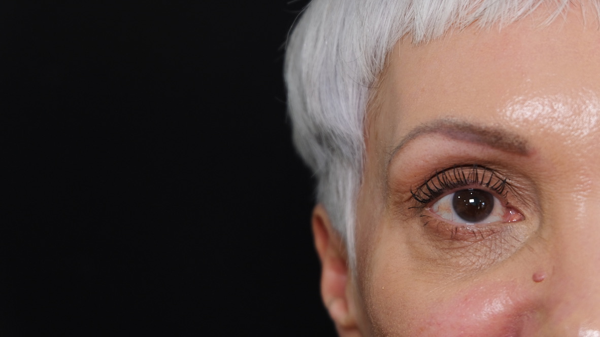 Temple volume loss before dermal filler treatment - side profile view showing hollowed temple area