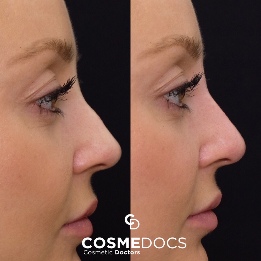 Non-invasive nose job immediate results London Cosmedocs Dr Ahmed Haq